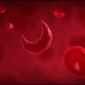Sickle cell anemia