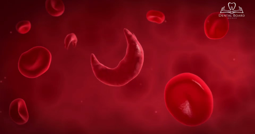 Sickle cell anemia